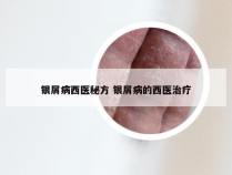 银屑病西医秘方 银屑病的西医治疗