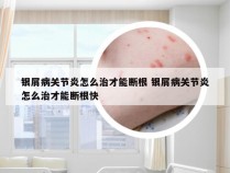 银屑病关节炎怎么治才能断根 银屑病关节炎怎么治才能断根快