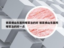 银屑病山东医院哪家治的好 银屑病山东医院哪家治的好一点