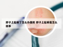 脖子上起癣了怎么办图库 脖子上起癣是怎么回事