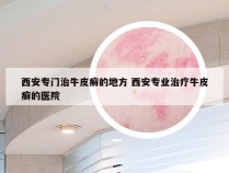 西安专门治牛皮癣的地方 西安专业治疗牛皮癣的医院