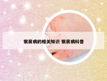 银屑病的相关知识 银屑病科普