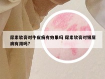 尿素软膏对牛皮癣有效果吗 尿素软膏对银屑病有用吗?