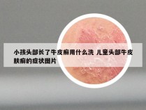 小孩头部长了牛皮癣用什么洗 儿童头部牛皮肤癣的症状图片