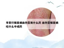 寻常行银屑病血热型用什么药 血热型银屑病吃什么中成药