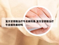 复方甘草酸治疗牛皮癣效果 复方甘草酸治疗牛皮癣效果好吗