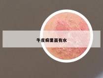 牛皮癣里面有水
