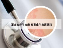 正定治疗牛皮癣 石家庄牛皮屑医院