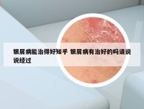 银屑病能治得好知乎 银屑病有治好的吗请说说经过