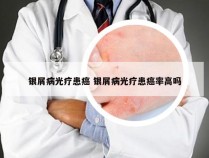 银屑病光疗患癌 银屑病光疗患癌率高吗