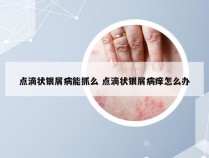 点滴状银屑病能抓么 点滴状银屑病痒怎么办