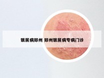 银屑病郑州 郑州银屑病专病门诊