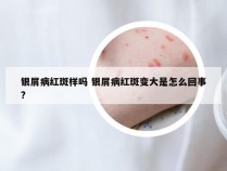 银屑病红斑样吗 银屑病红斑变大是怎么回事?