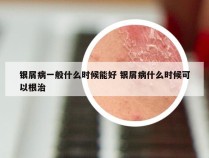 银屑病一般什么时候能好 银屑病什么时候可以根治