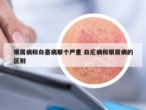 银屑病和白塞病那个严重 白庀病和银屑病的区别