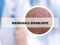 银屑病科技前沿 银屑病前沿研究