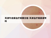 天津牛皮癣治疗需要价格 天津治疗银屑病专科