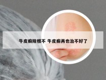 牛皮癣除根不 牛皮癣再也治不好了