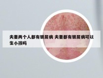 夫妻两个人都有银屑病 夫妻都有银屑病可以生小孩吗