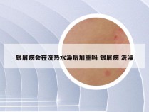 银屑病会在洗热水澡后加重吗 银屑病 洗澡