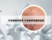 牛皮癣国外研究 牛皮癣研究最新进展