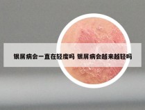 银屑病会一直在轻度吗 银屑病会越来越轻吗