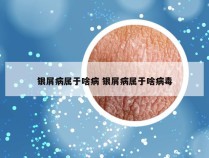 银屑病属于啥病 银屑病属于啥病毒