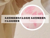 头皮型银屑病为什么会出现 头皮型银屑病为什么会出现脱发