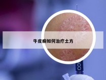 牛皮癣如何治疗土方