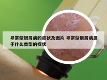 寻常型银屑病的症状及图片 寻常型银屑病属于什么类型的症状