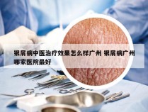 银屑病中医治疗效果怎么样广州 银屑病广州哪家医院最好