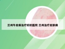 兰州牛皮癣治疗好的医院 兰州治疗皮肤病