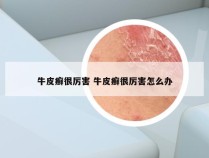 牛皮癣很厉害 牛皮癣很厉害怎么办