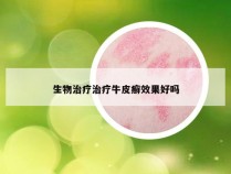 生物治疗治疗牛皮癣效果好吗