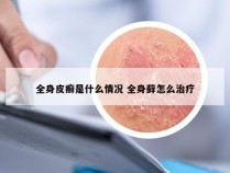 全身皮癣是什么情况 全身藓怎么治疗