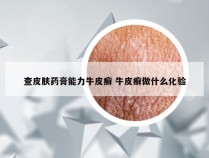 查皮肤药膏能力牛皮癣 牛皮癣做什么化验