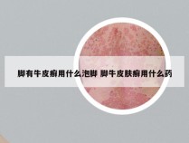 脚有牛皮癣用什么泡脚 脚牛皮肤癣用什么药