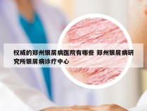 权威的郑州银屑病医院有哪些 郑州银屑病研究所银屑病诊疗中心