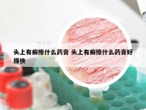 头上有癣擦什么药膏 头上有癣擦什么药膏好得快