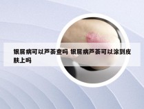 银屑病可以芦荟查吗 银屑病芦荟可以涂到皮肤上吗