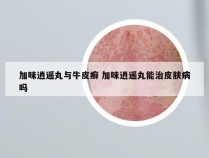 加味逍遥丸与牛皮癣 加味逍遥丸能治皮肤病吗