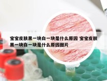 宝宝皮肤黑一块白一块是什么原因 宝宝皮肤黑一块白一块是什么原因图片