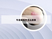 牛皮癣裂开怎么回事