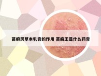 苗癣灵草本乳膏的作用 苗癣王是什么药膏