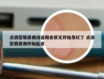 点滴型银屑病消退期皮疹又开始发红了 点滴型银屑病开始起皮