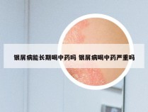 银屑病能长期喝中药吗 银屑病喝中药严重吗