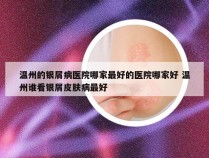 温州的银屑病医院哪家最好的医院哪家好 温州谁看银屑皮肤病最好