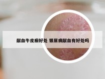 献血牛皮癣好处 银屑病献血有好处吗