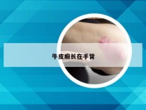 牛皮癣长在手背