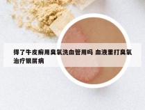 得了牛皮癣用臭氧洗血管用吗 血液里打臭氧治疗银屑病
